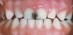 decayed baby teeth