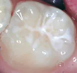 tooth surface after a sealant