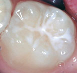 tooth surface after a sealant