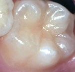 tooth surface before sealant