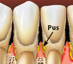 Advanced Periodontitis and a mouth with pus