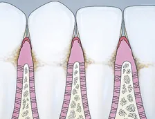 Drawing of a teeth and gums being surrounded by plaque