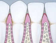 Drawing of a teeth and gums being surrounded by plaque