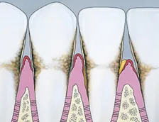 Drawing of gums with Periodontitis disease