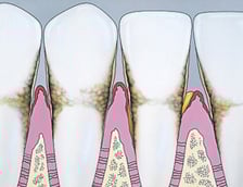 Drawing of gums with Periodontitis disease
