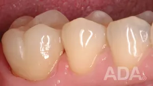 Teeth after a crown