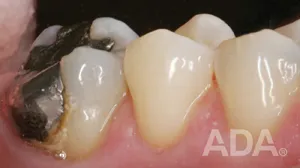 Teeth with decay