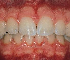 Smiling mouth with ginigivitis