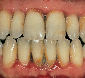 Image of gums with Periodontitis disease