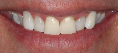 White teeth after tooth whitening