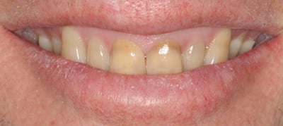 Brown discolored teeth before photo